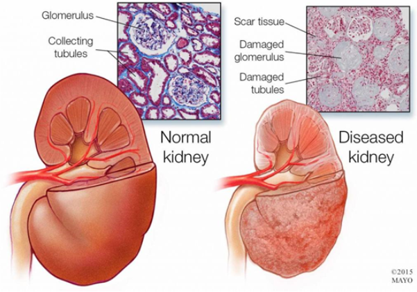 kidney_two